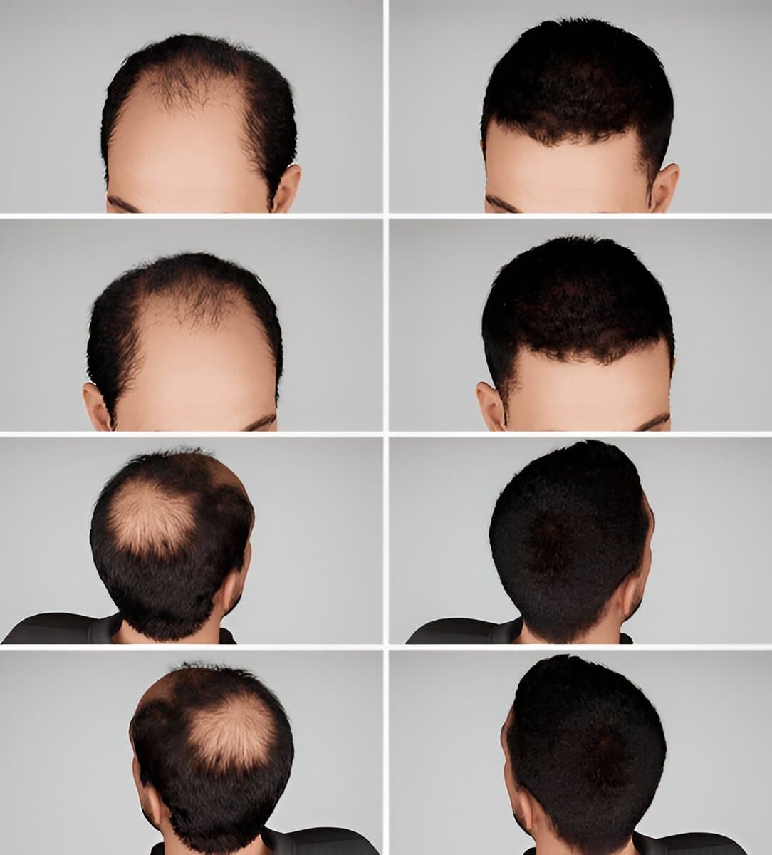 Hair loss and hair regrowth treatment at Calyx Skin Lab